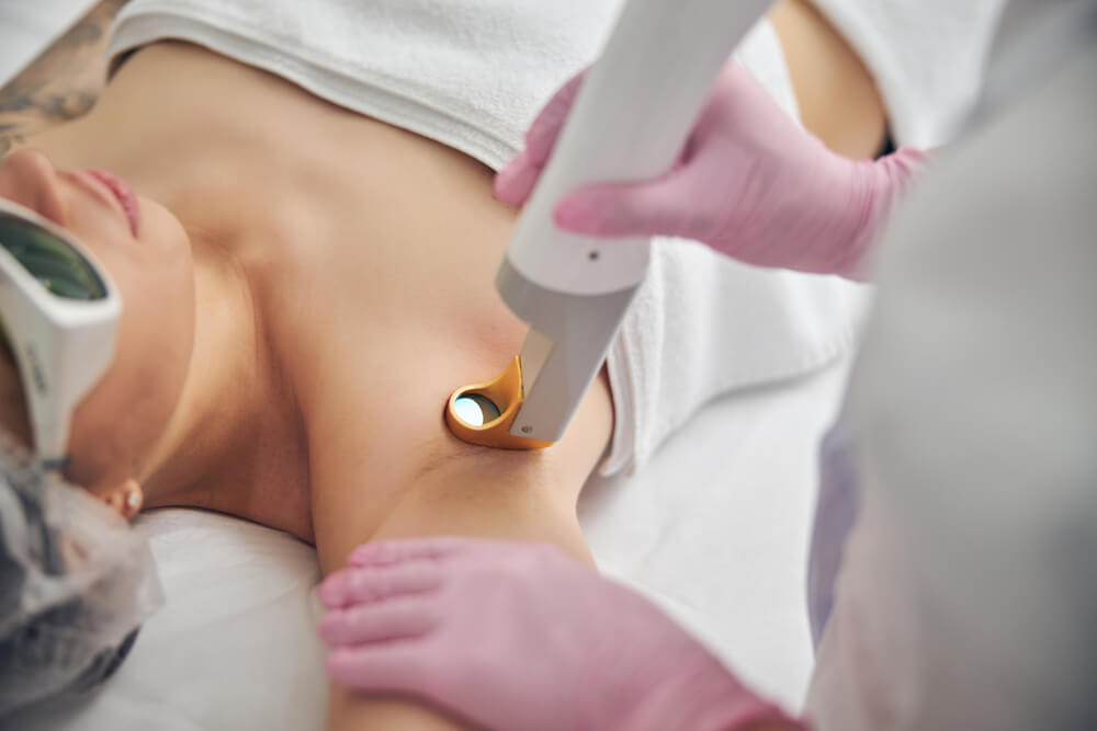 Medical laser hair removal treatment being performed on a patient in Irvine, California